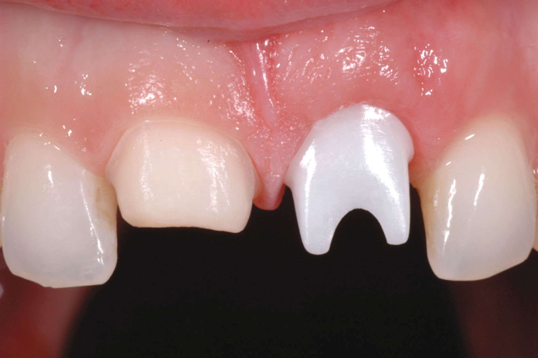 Implant dental lab abutment