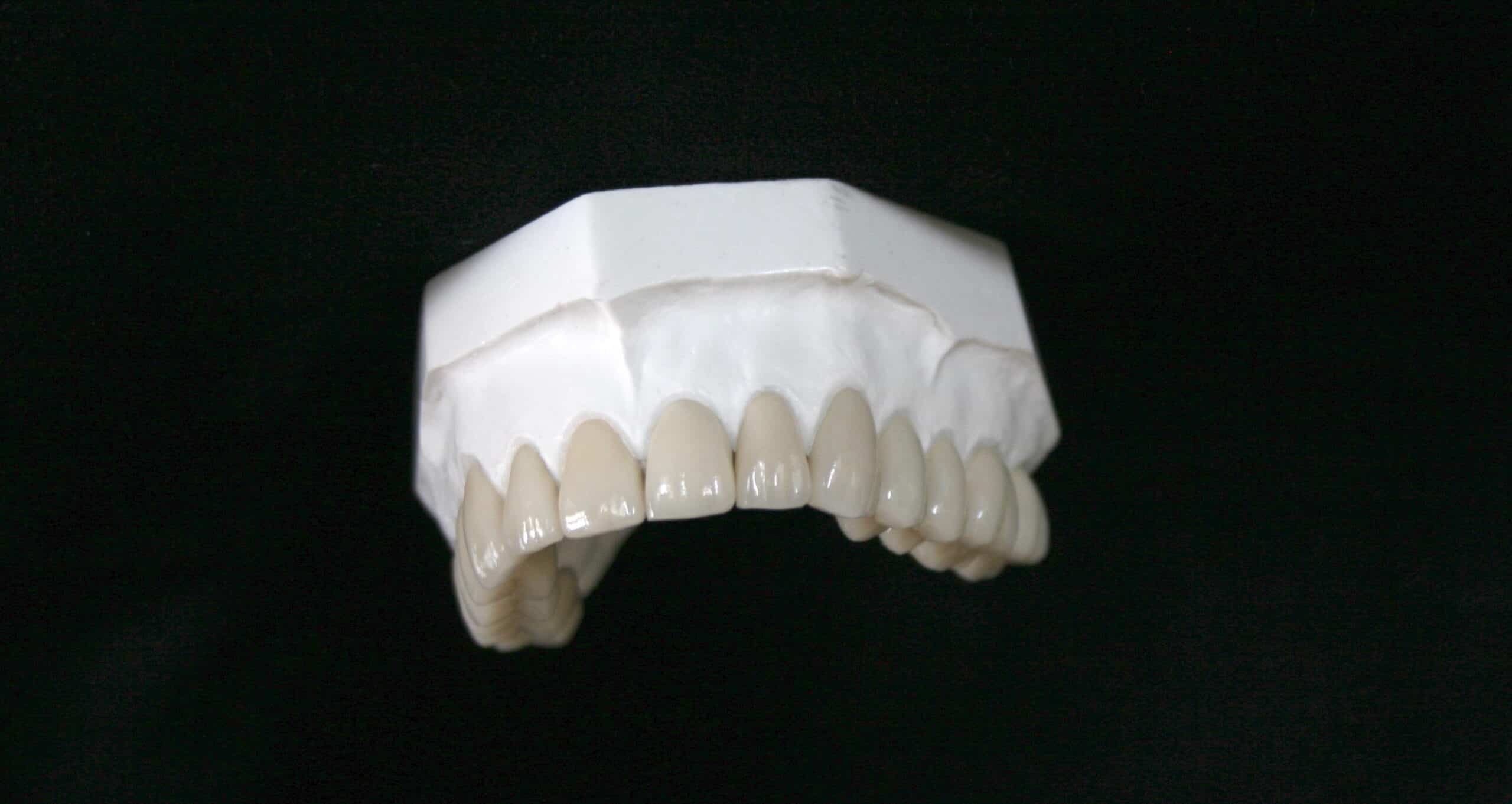 Implant Restoration Image